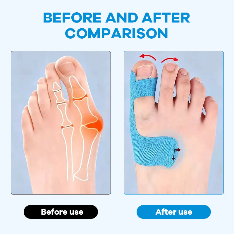 Cut Bunion Corrector Kinesiology Tape– Elastic, Breathable & Hypoallergenic Latex-Free Toe Support Strips